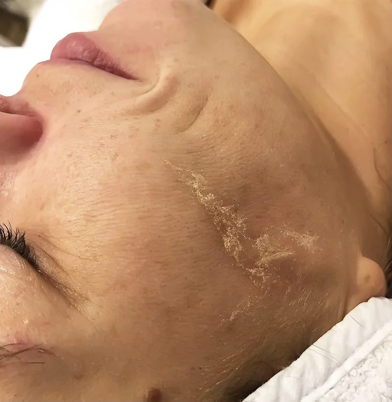 dermaplaning