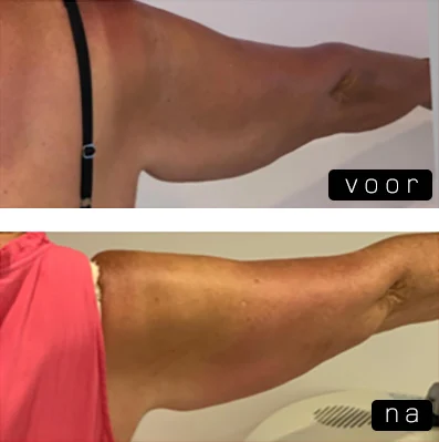 Radiofrequentie Therapie case 1