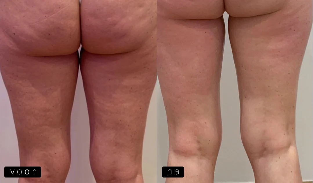 Radiofrequentie Therapie case 2